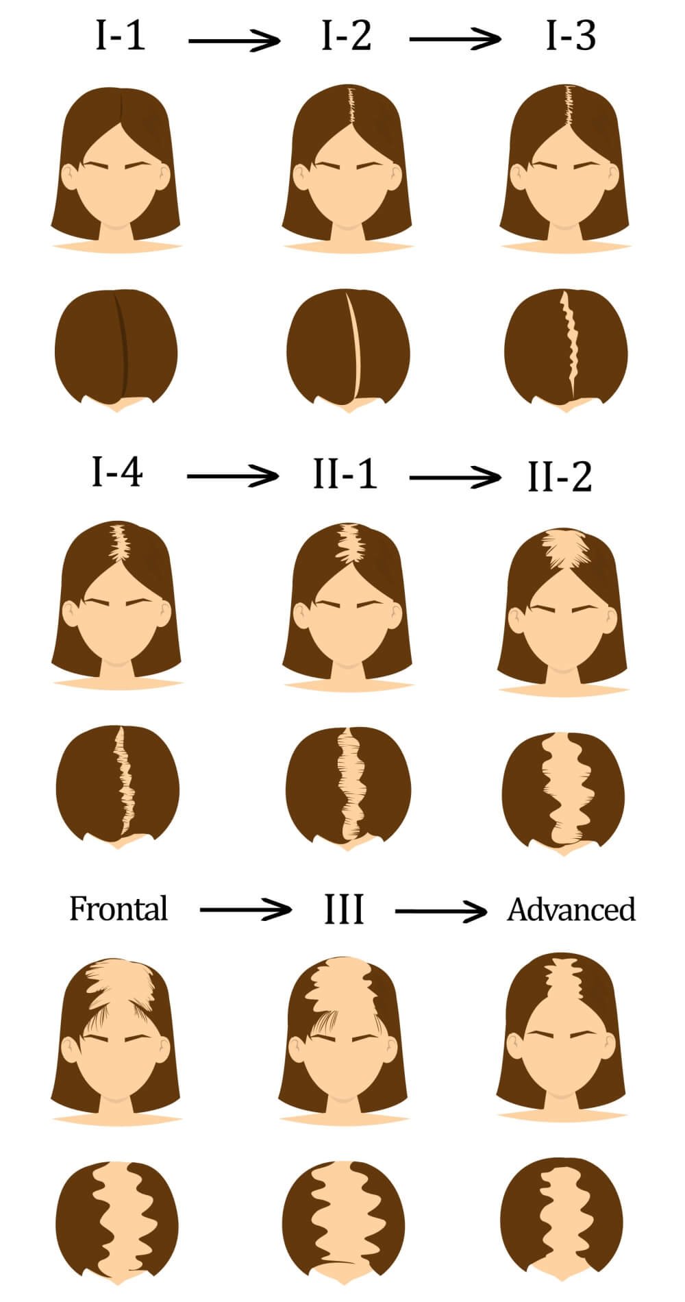Female-pattern-hair-loss-Figure
