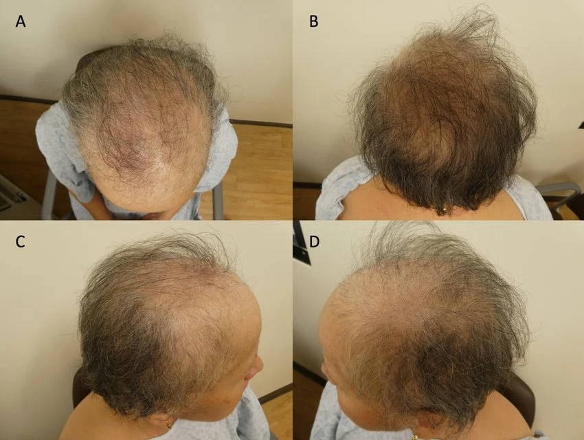 Minoxidil-responsive-alopecia-following-treatment-of-a-breast-cancer-female-patient-with