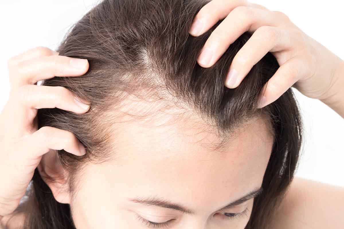 hair_loss
