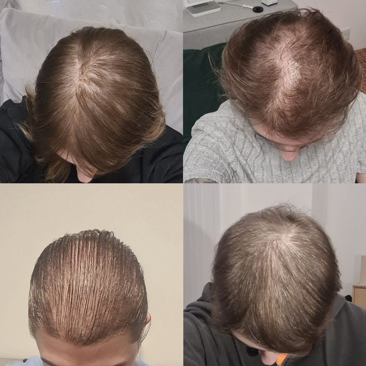 recovery-hairloss-photos-after-telogen-effluvium-v0-ccfbmzylyewe1