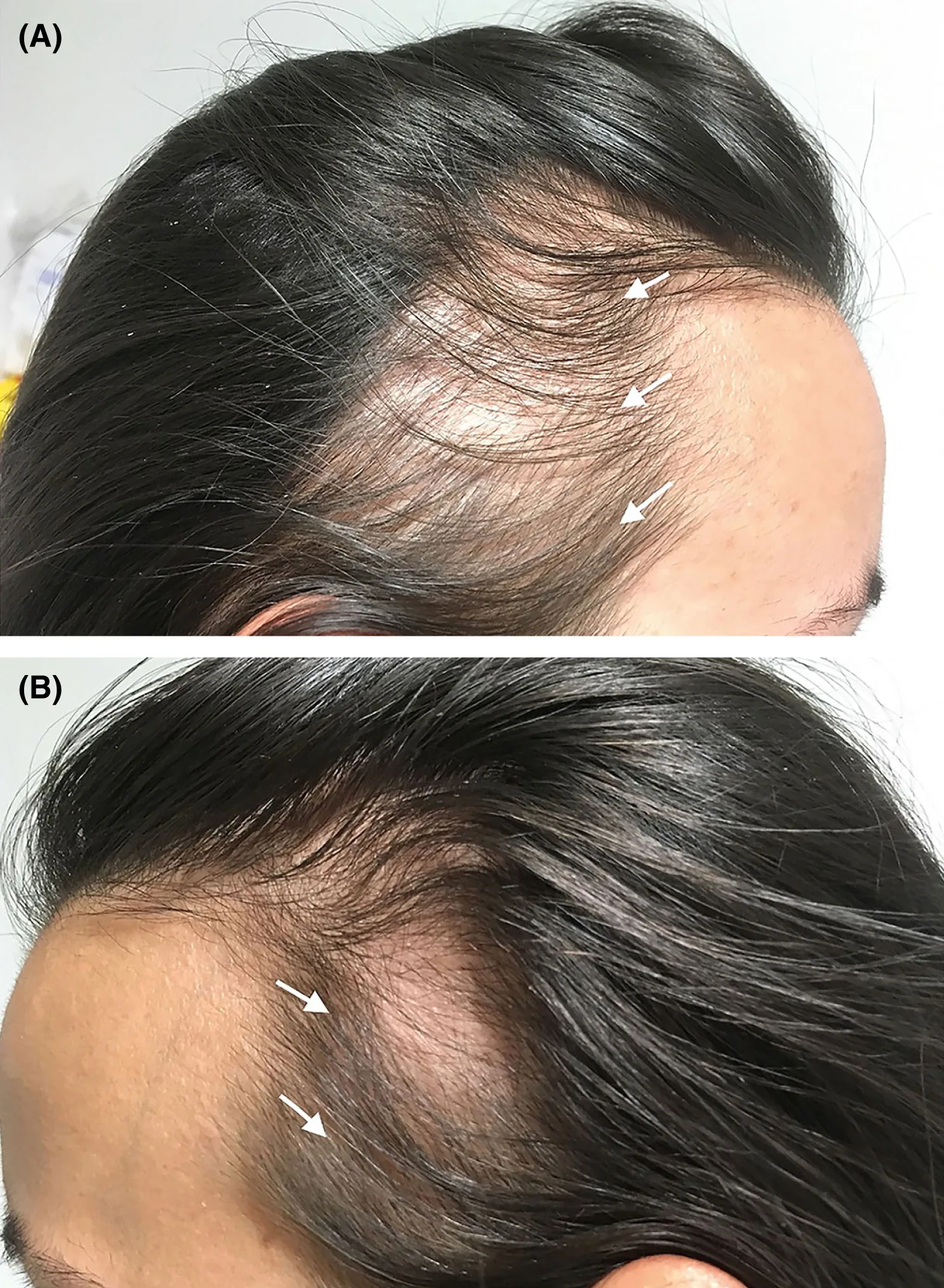 traction-alopecia-1.jpg